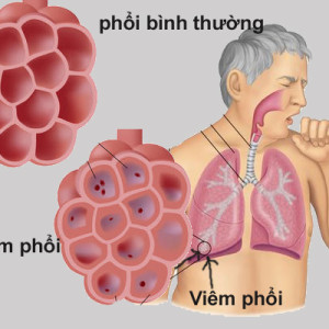 Tổng quan về bệnh viêm phổi