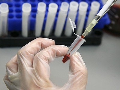 Các xét nghiệm cần làm trong nhiễm khuẩn huyết