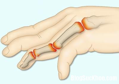 Phương pháp chữa bệnh viêm khớp ngón tay