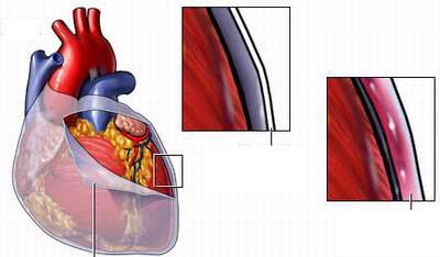 Viêm màng ngoài tim co thắt và những thông tin cần biết