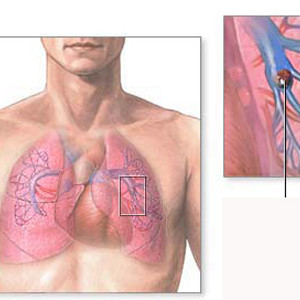 Xơ phổi và những điều bạn cần biết
