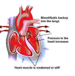 Suy tim ứ huyết và những điều cần biết
