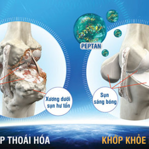 Sự biến đổi xương dưới sụn trong thoái hoá khớp