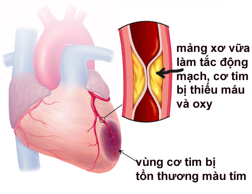 Tìm hiểu biến chứng “nhồi máu cơ tim” do tăng huyết áp