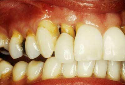 Bệnh tiểu đường ảnh hưởng đến răng miệng như thế nào?