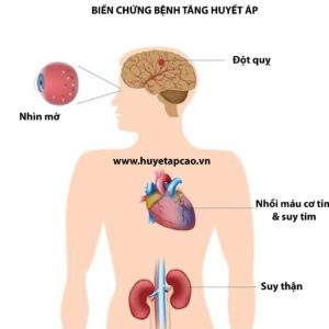 Tại sao huyết áp cao được xem là “kẻ giết người thầm lặng”