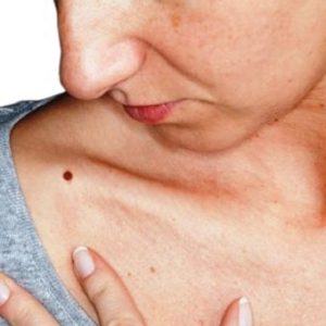 6 dấu hiệu của bệnh ung thư da bạn không nên bỏ qua