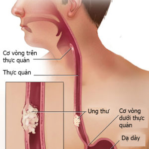 Hút nhiều thuốc lá và uống nhiều rượu bia dễ ung thư thực quản