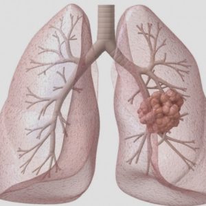 Tại sao hút thuốc và sáng sớm lại nguy cơ cao mắc ung thư phổi
