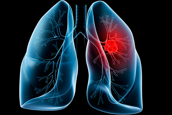 Tìm hiểu những triệu chứng của bệnh ung thư phổi