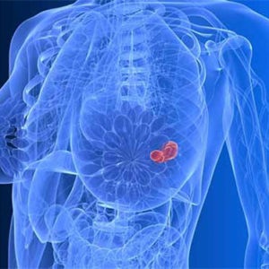 Những nguyên nhân mắc bệnh ung thư vú ở nam và nữ