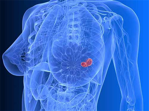 Những nguyên nhân mắc bệnh ung thư vú ở nam và nữ