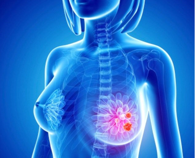 Những loại bệnh ung thư thường gặp ở phụ nữ