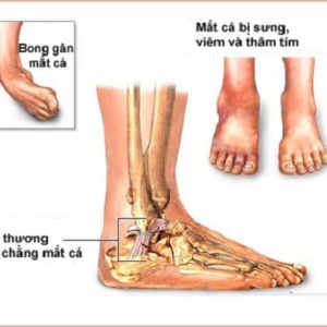 Nguyên nhân và dấu hiệu bệnh viêm khớp cổ chân