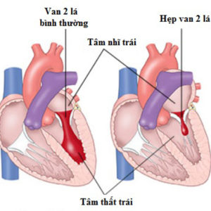 Những thông tin bổ ích về bệnh hở van tim