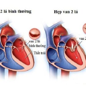 Những điều cần biết về bệnh hẹp van tim