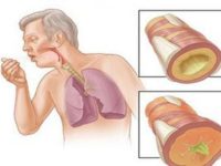 Nguyên nhân, triệu chứng của bệnh lao phổi