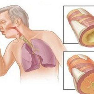 Nguyên nhân, triệu chứng của bệnh lao phổi