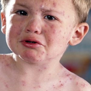Những điều cần biết về viêm da dị ứng ở trẻ em