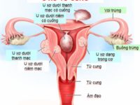 Triệu chứng và cách phòng chống bệnh u xơ tử cung