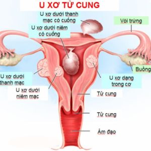 Triệu chứng và cách phòng chống bệnh u xơ tử cung