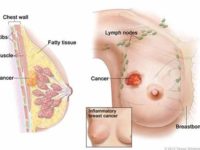 Các thông tin cần biết về ung thư vú