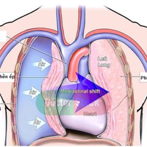Bạn đã biết gì về bệnh tràn khí màng phổi chưa?