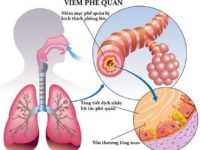 Một số điều cần biết về bệnh viêm phế quản