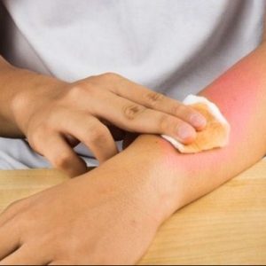 Cách làm liền vết bỏng trên da không để lại sẹo