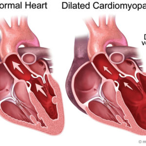 Bạn đã biết gì về bệnh viêm cơ tim chưa?