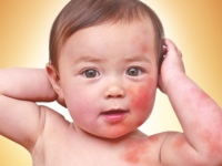 Bệnh chàm làm xuất hiện những vết đỏ trên da trẻ