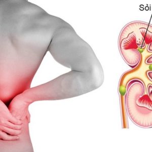 Bệnh sỏi thận và cách chữa bệnh sỏi thận tại nhà hiệu quả nhất
