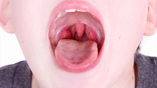 Bệnh viêm họng hạt nếu không chữa trị kịp thời sẽ gây biến chứng nguy hiểm