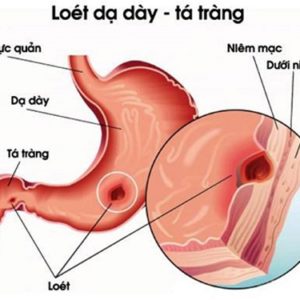 Cách giảm axit dạ dày đơn giản tại nhà, ai cũng phải biết