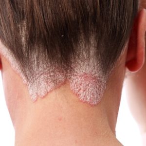 Chia sẻ 3 cách chữa bệnh nấm da đầu tại nhà đơn giản mà hiệu quả