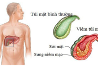 Sỏi mật là căn bệnh nguy hiểm nếu không điều trị kịp thời