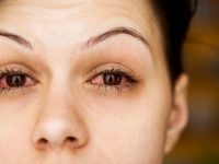 Khô mắt là một trong những chứng bệnh có thể gặp ở bất kì ai