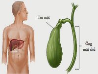 Cần phát hiện và điều trị polyp túi mật sớm