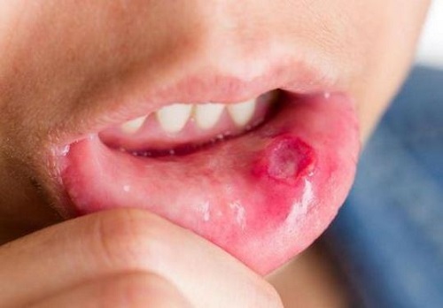 Nhiệt miệng gây ảnh hưởng đến sức khỏe, sinh hoạt