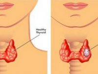 Ung thư vòm họng và những điều bạn cần biết