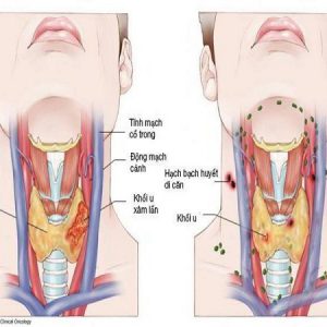 Ung thư vòm họng giai đoạn đầu: Dấu hiệu, chẩn đoán, điều trị