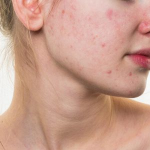Bị dị ứng da mặt nên kiêng ăn gì – Lời khuyên từ những chuyên gia