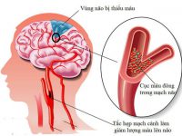 Cảnh giác với cơn thiếu máu não thoáng qua