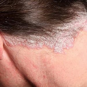 Cách điều trị bệnh vảy nến da đầu tại nhà