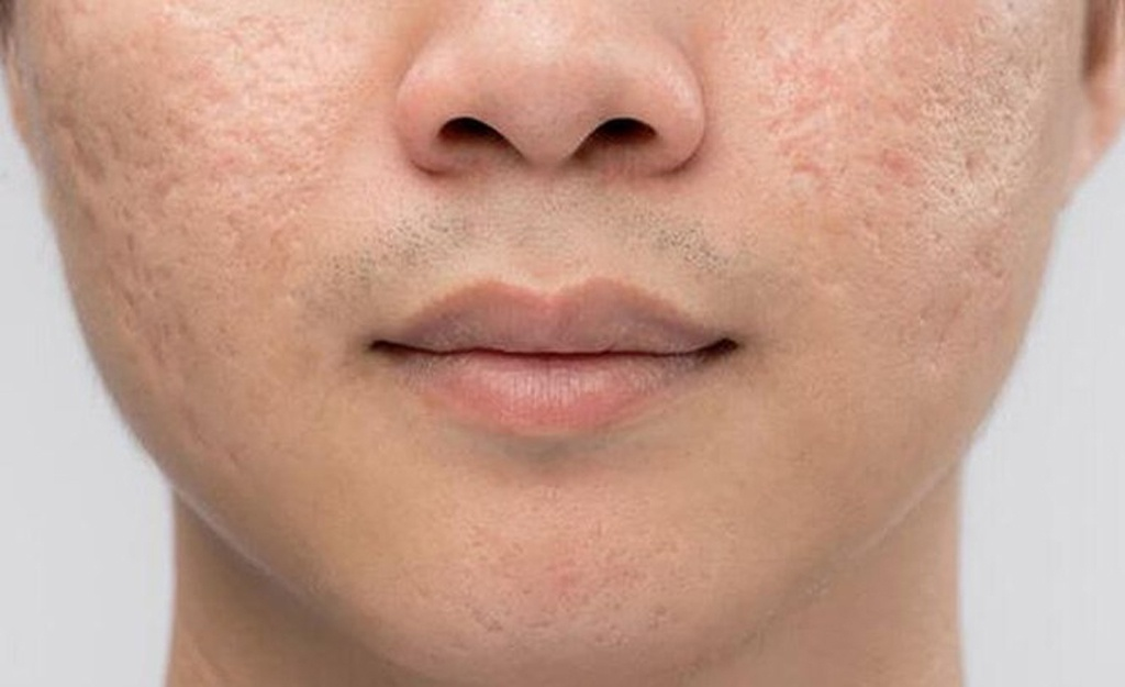 Sẹo mụn là các vấn đề phổ biến trên da mặt