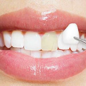 Hướng dẫn cách dán răng giả bị rớt, bị gãy đơn giản nhất