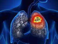 Tiên lượng cho người mắc ung thư phổi 