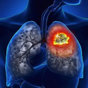 Người bị bệnh ung thư phổi sống được bao lâu