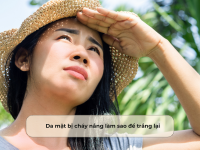 Da mặt bị cháy nắng làm sao để trắng lại