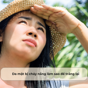 Da mặt bị cháy nắng làm sao để trắng lại? Giải pháp phục hồi nhanh tại nhà